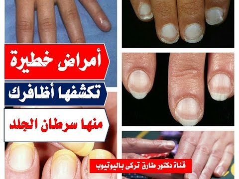 اكتشف ١٥ مرض من خلال أظافرك امراض خطيره تكشف عنها اظافرك اخطرها سرطان الجلد