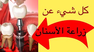 ما هي زرعات الأسنان ؟ الموضوع غير مخيف ? |الدكتور محمد صادقلي