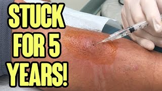 Leg Double Feature - Infected Leg and Amazing Toothpick Splinter Removal