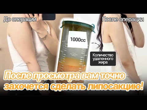 Липосакци Рук До и После операции