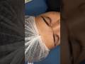 limpeza satisfatoria de acne e comedões