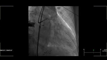 In Stent Circumflex CTO solved via HDR