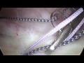 Shoulder Instability Surgery, Arthroscopic