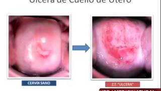 LESIONES EN EL CUELLO UTERINO lesiones en el cuello uterino: