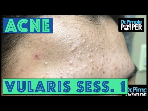 Stubborn Whitehead Extractions & Acne Vulgaris: Session 1