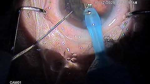 How to perform Carousel Technique in Soft Cataract