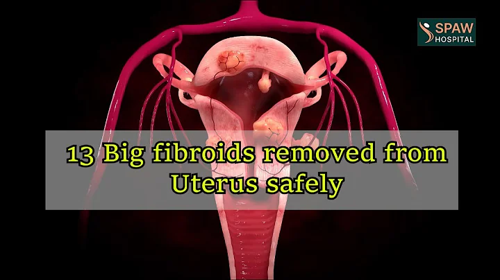 13 big fibroids Removed safely |  DR. HARMANPREET KAUR | SPAW Hospital