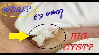 REMOVE LARGE TWO CYST ON TWO EAR (63) | Loan Nguyen