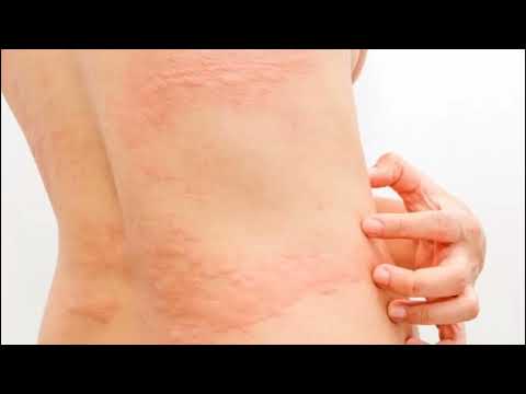 URTICARIA RONCHAS EN EL CUERPO CAUSAS SÍNTOMAS Y TRATAMIENTO