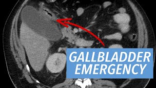Emergency Radiology Case Series: Acute Diagnoses of the Abdomen & Pelvis