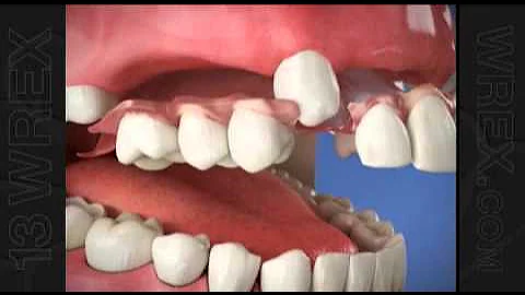 Flexible Partial Dentures