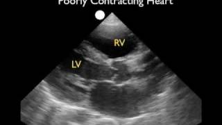 Cardiac Ultrasound - Parasternal Long Axis - Part 2 - Sonosite Inc