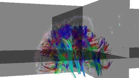 Diffusion Tensor Tractography MRI - William Edward Hahn