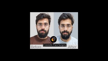 Facial Asymmetry Treatment | Before - After Results | Aldaim Dental Center | Dr Tauseef Ahmad