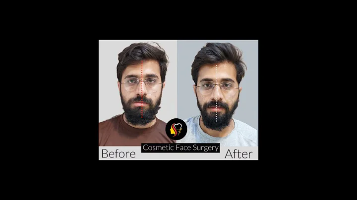 Facial Asymmetry Treatment | Before - After Results | Aldaim Dental Center | Dr Tauseef Ahmad
