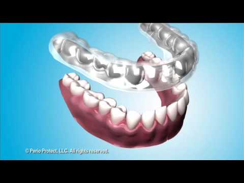 Treating Periodontal Disease with the Perio Protect Method™