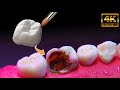 Restauración dental Extrema!