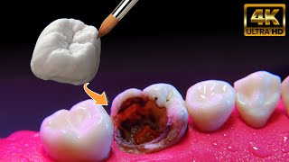 Restauración dental Extrema
