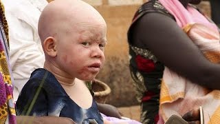Malawi: Amnesty tire la sonnette d'alarme pour la protection des albinos
