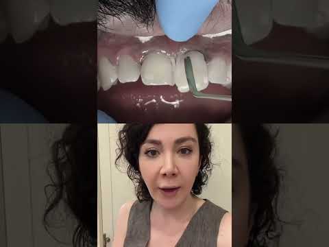 What Are Options To Close The Front Teeth’s Gap?!