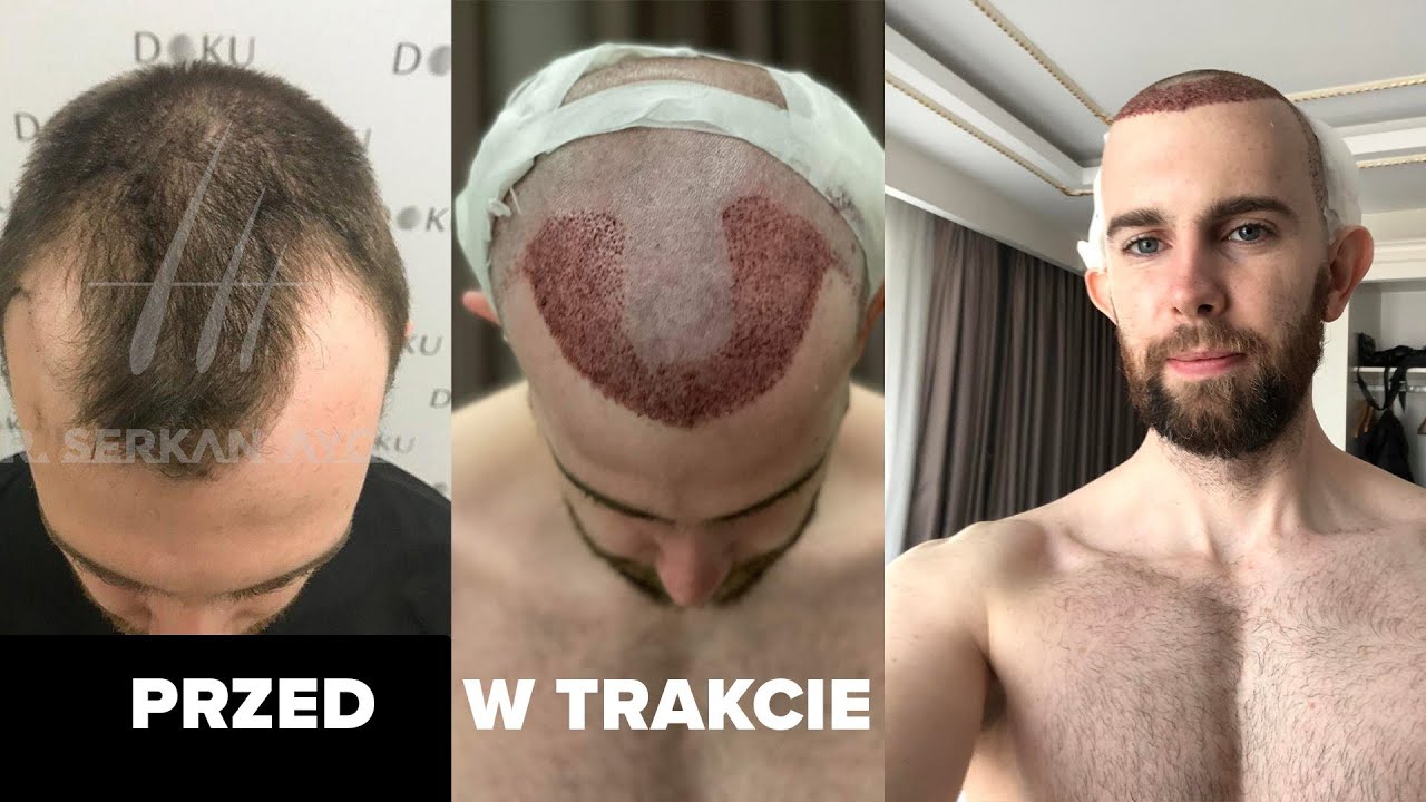 Zrobiłem PRZESZCZEP WŁOSÓW na zakola w TURCJI *dużo zdjęć* - YouTube