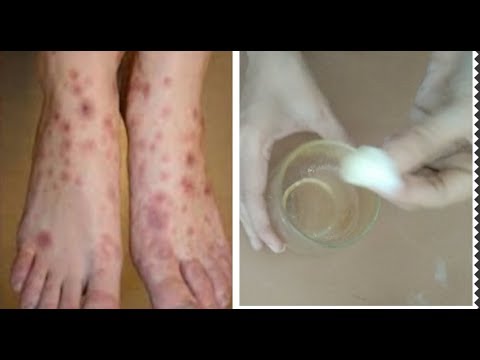 Hilangkan Bekas Koreng Dan Bekas Luka Hitam Menahun Youtube