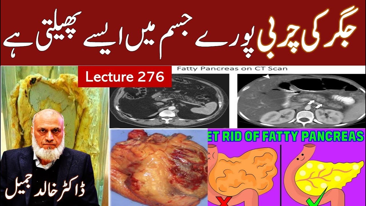 How Fatty liver spread to All organs Lecture 276 YouTube