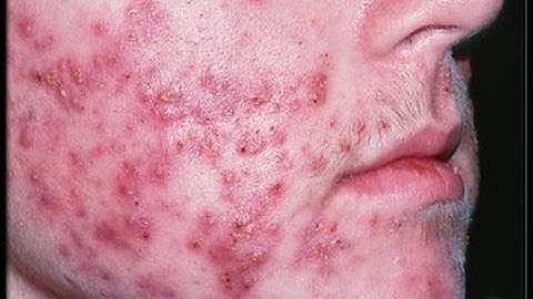 Revealed: LA-MRSA, the pig superbug living in your fridge | Guardian Investigations