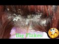 Amazing Huge Flakes Scratching Dandruff off Scalp Big Flakes ITCHY DRY SCALP | RAKING SCALP
