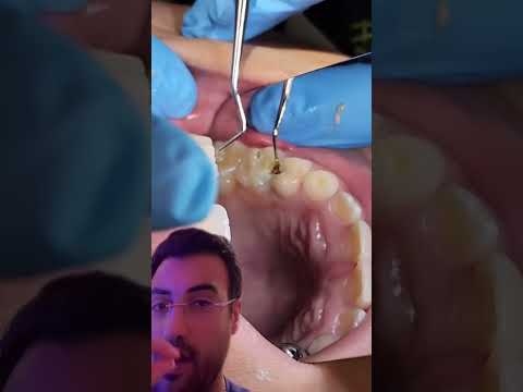 Vídeo: Os dentes cariados caem?