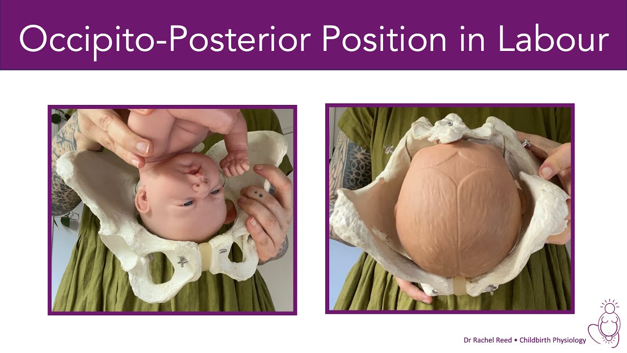 posterior presentation in labour