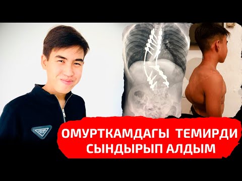 Омурткама салдырган темир сынып кетти