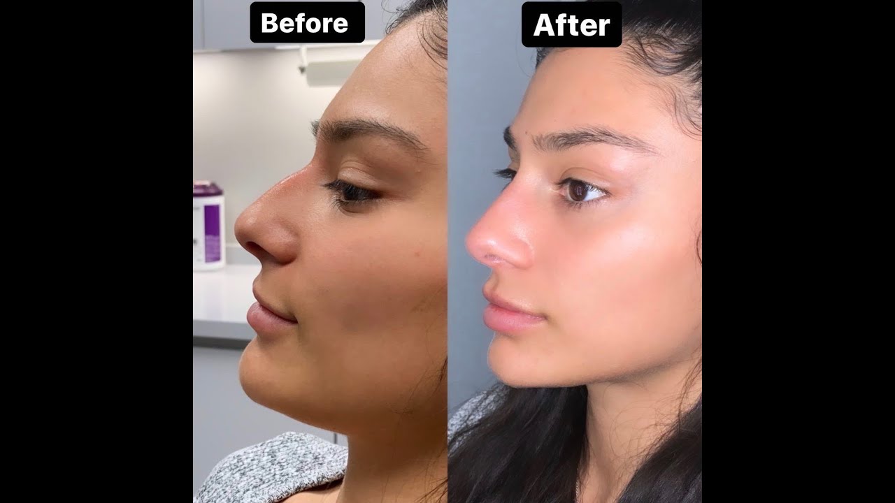 I GOT A NONSURGICAL NOSE JOB YouTube