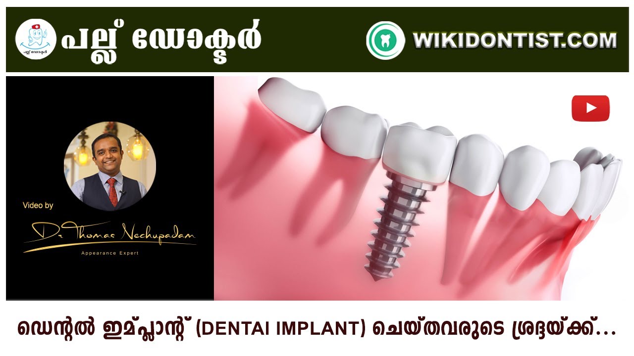 ഡെന്റൽ ഇമ്പ്ലാന്റ്‌ ചെയ്തവരുടെ ശ്രദ്ദയ്ക്ക്...Follow up after Dental Implant Treatment...