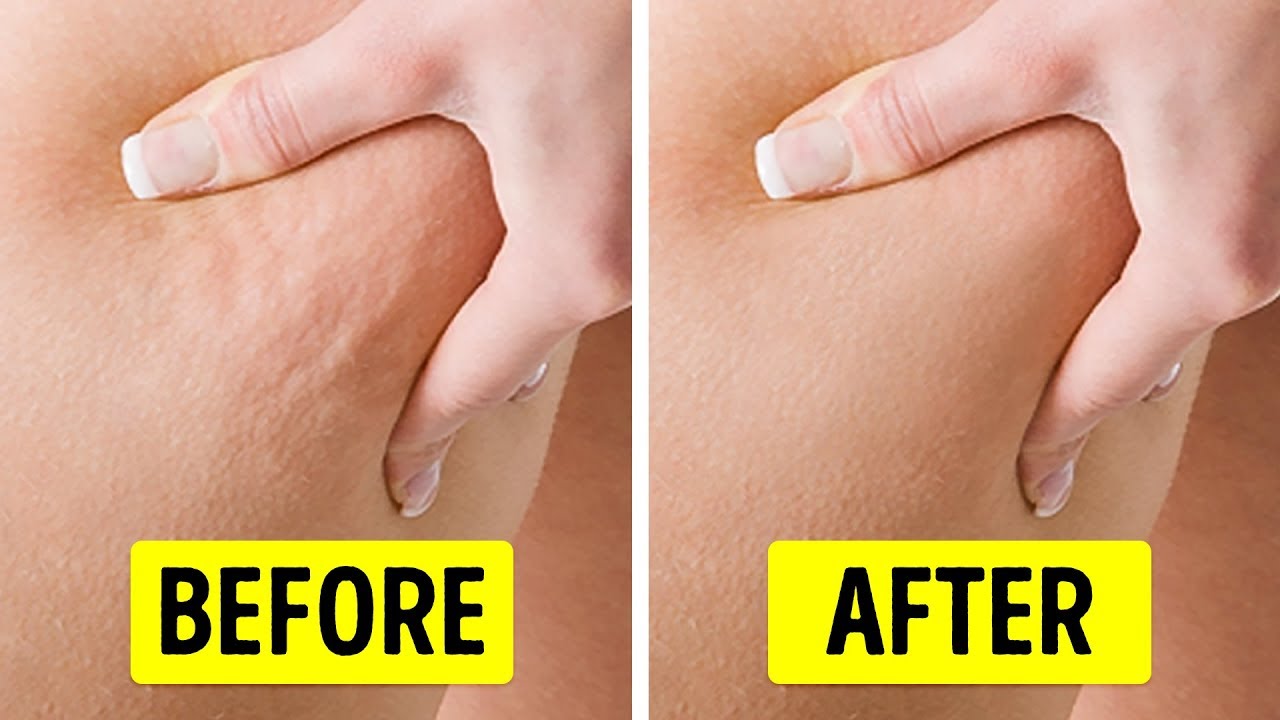 5 Ways On How To Get Rid Of Cellulite On Arms - Weightworld Can Be Fun For Everyone thumbnail