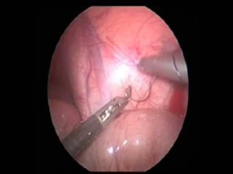 catheter laparoscopic placement