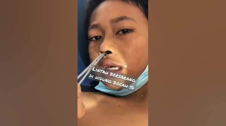 lintah bersarang di hidung bocah SD #shorts #viral