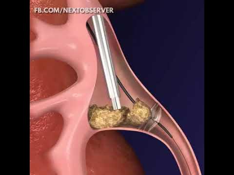 Cystoscopic Laser Lithotripsy and Stone Extraction (Cystolithalopaxy