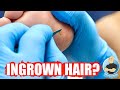 INGROWN HAIR GROWING OUT OF HER FOOT?!