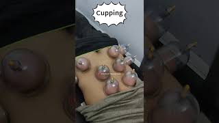 hip & back pain relief #shorts #cupping