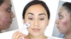 HOW I GOT RID OF ACNE SCARS | DERMA ROLLER | MICRONEEDLING | BANISH