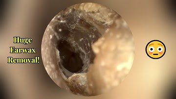 Extreme Earwax Removal 😱 | Oddly Satisfying Ear Cleaning Compilation