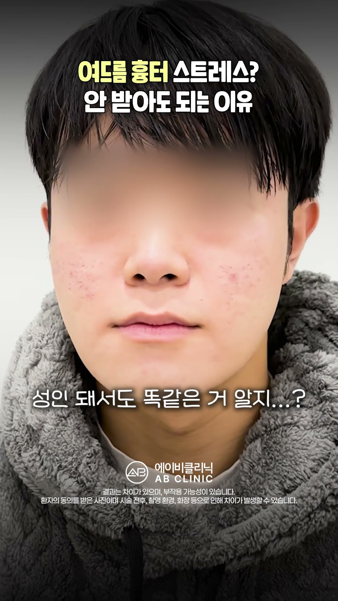 여드름 흉터는 큐어젯 시술로 해결!