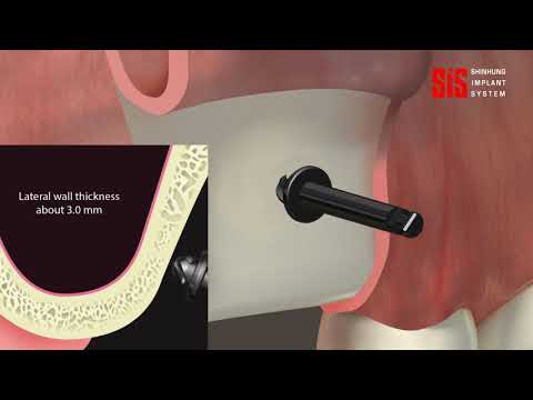 Sinus Lateral Approach Kit Overview
