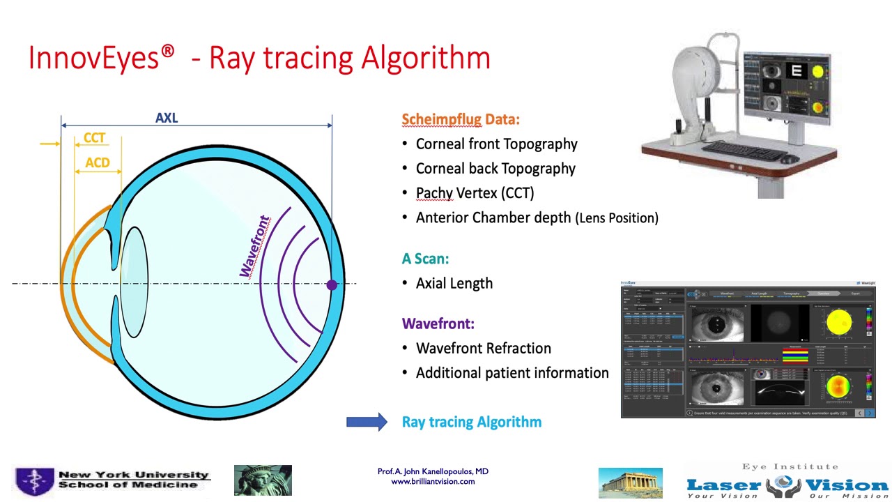 Initial Outcomes with Customized Myopic LASIK, Guided by Automated Ray ...