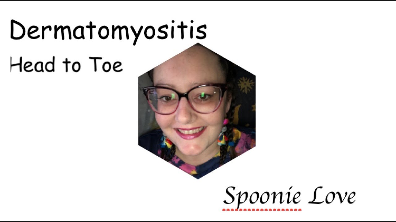 Dermatomyositis & How it Has Affected Me from Head to Toe