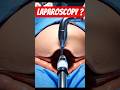 Hysterectomy By Camera? Here's How #hysterectomy #laproscopicsurgery #gynecology