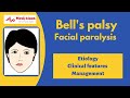 Bell's Palsy (Facial Palsy)