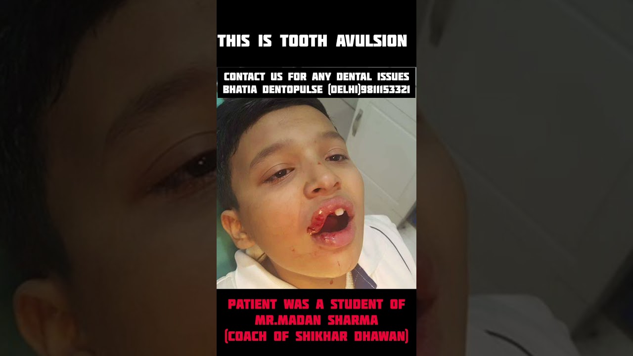 Tooth Avulsion-अपना ही दांत जो एक्सीडेंट से  निकल गया था उसी जगह पर दोबारा लगाया गया 