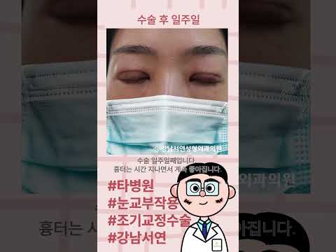 강남서연 타병원 눈매교정 부작용 조기교정 일주일 전후